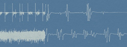 The Artificial Prolongation of Life and the Determination of the Exact Moment of Death